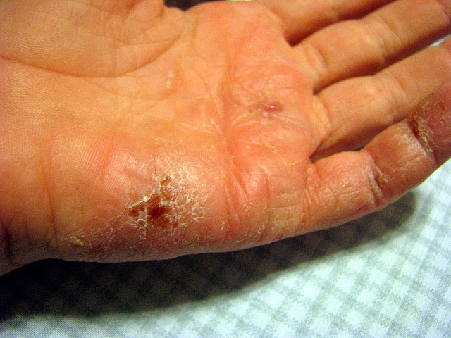 Eczema is back